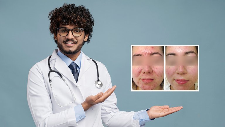 Acne Scar Treatment in Jaipur