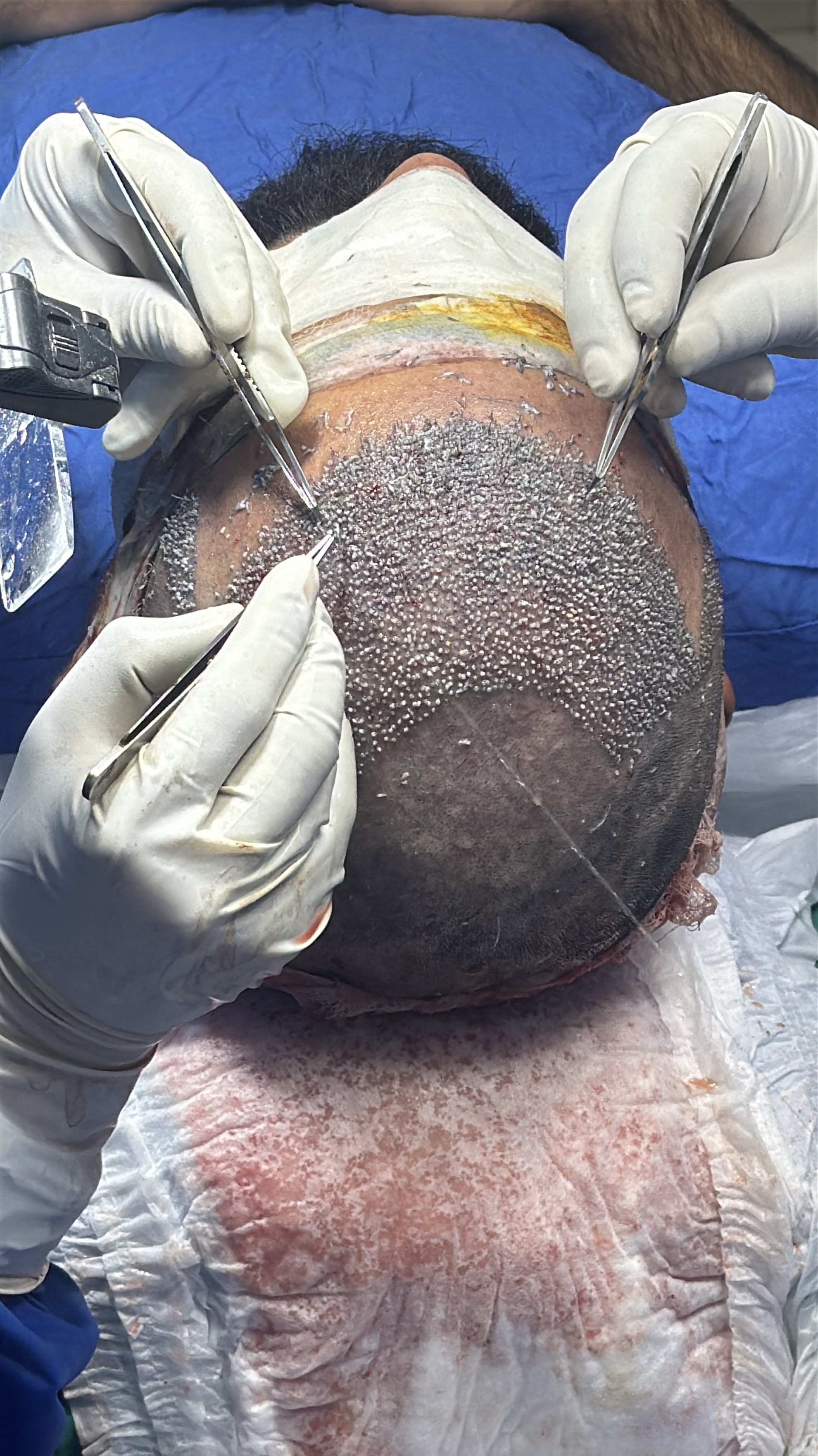 Expert Hair Transplant Treatment in Jaipur