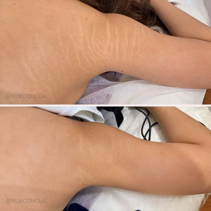 Scar Reduction Treatment in Jaipur